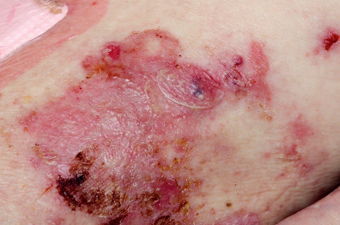 Pemphigoid blisters