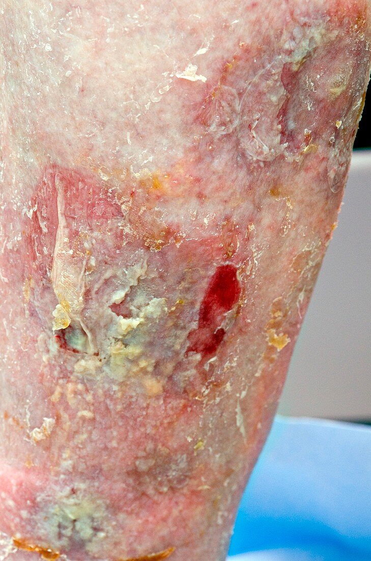 Pemphigoid blisters