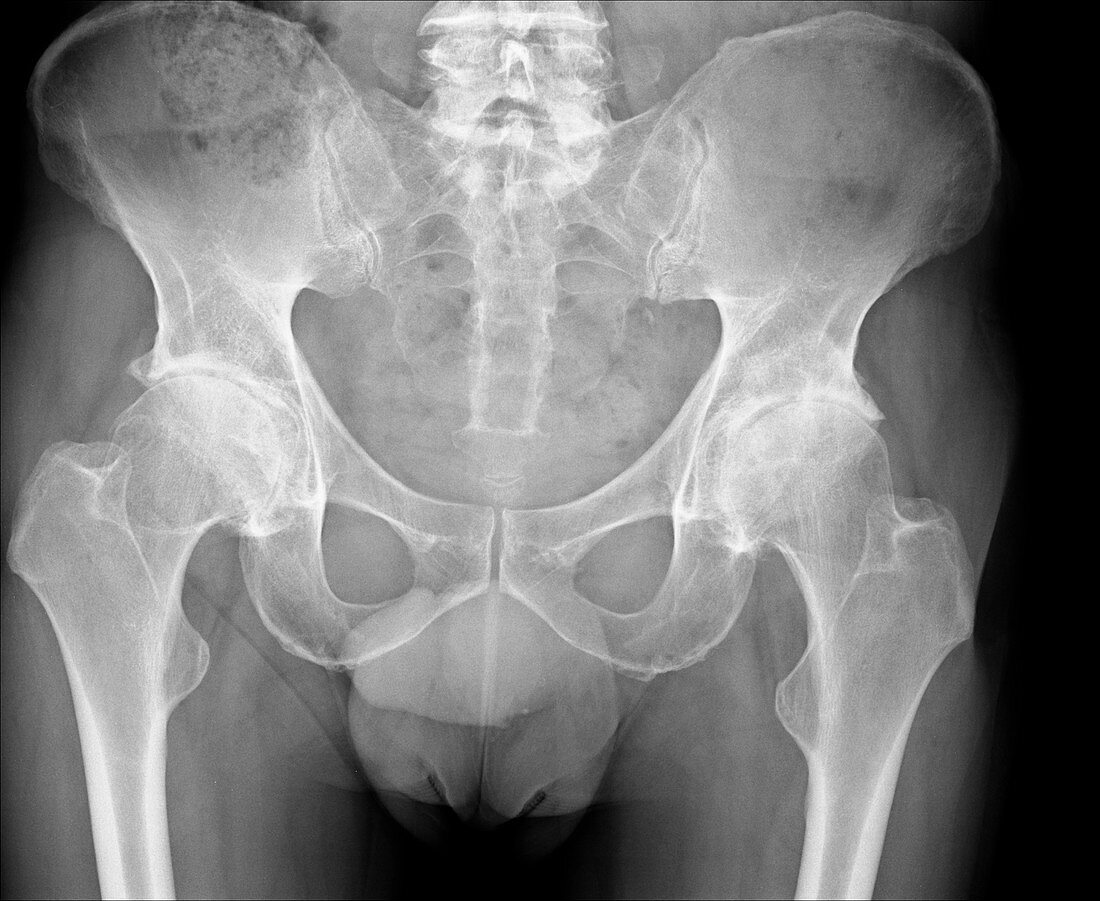 Osteoarthritis of the hips,X-ray