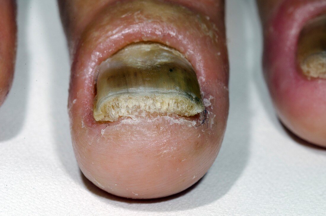 Psoriasis of the fingernail