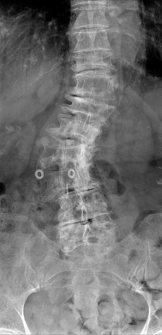 Spinal curvature,X-ray