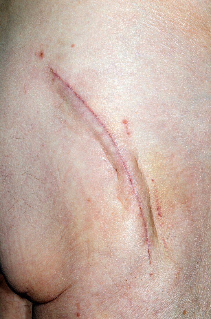 Scar from total hip replacement