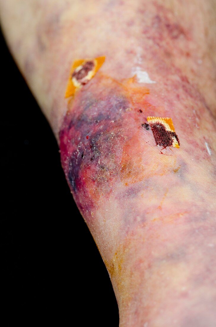 Leg bruising in warfarin patient