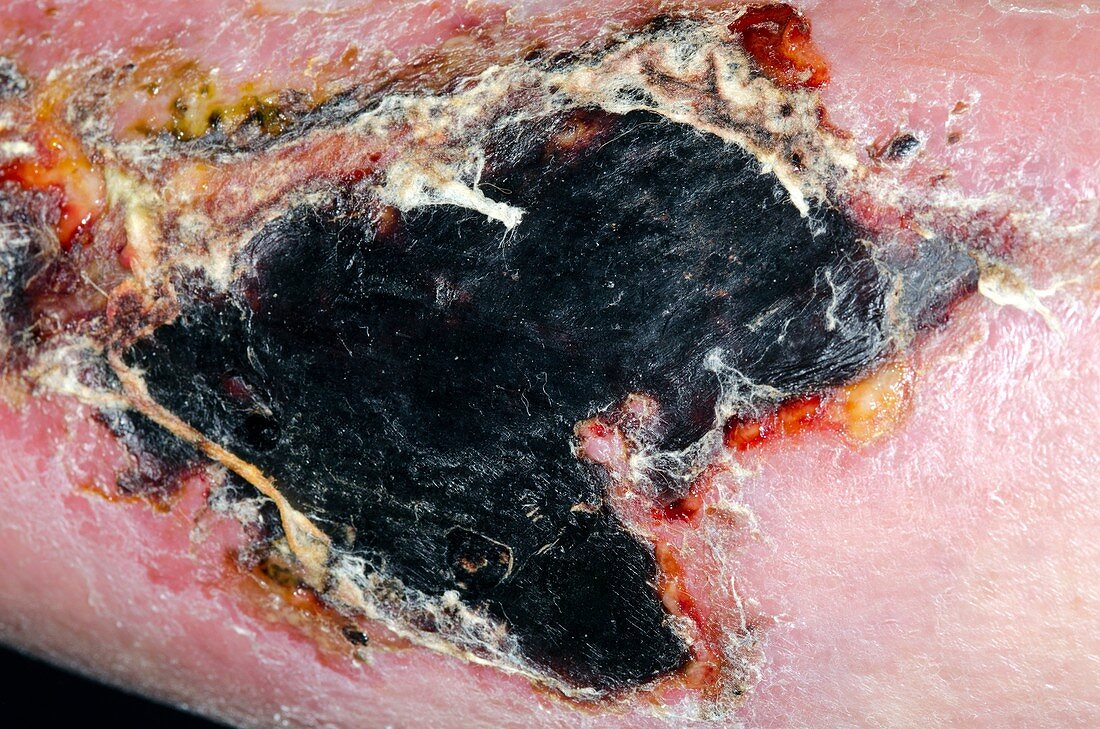 Wound scabbing after major trauma
