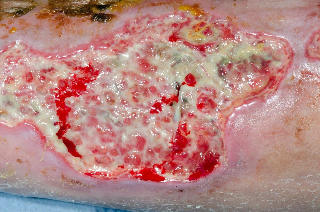 Wound infection after major trauma