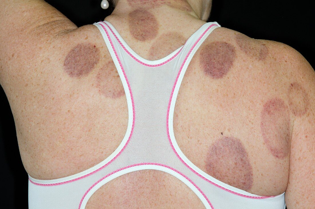 Bruises from Chinese cupping therapy