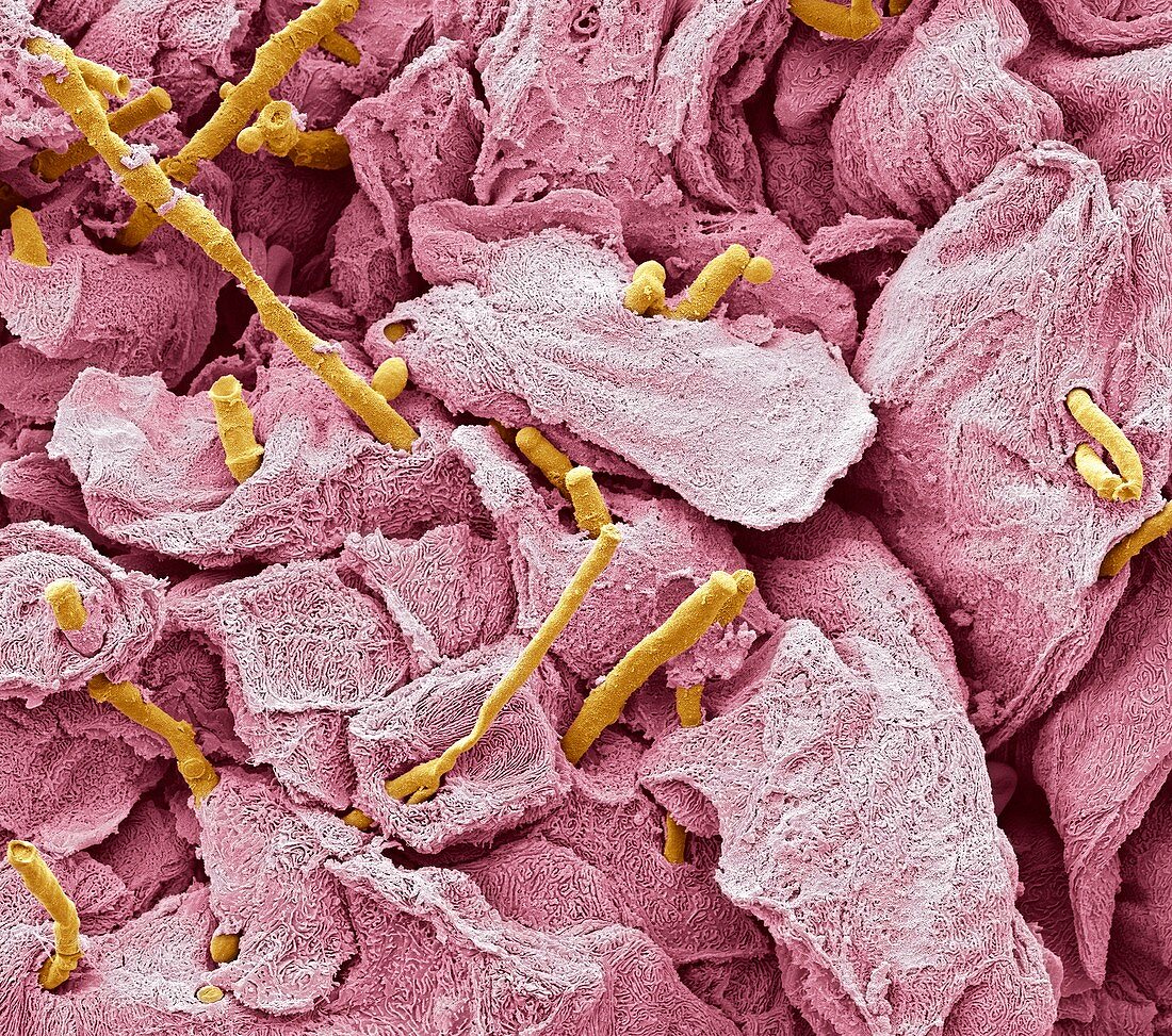 Thrush infection of the tongue,SEM
