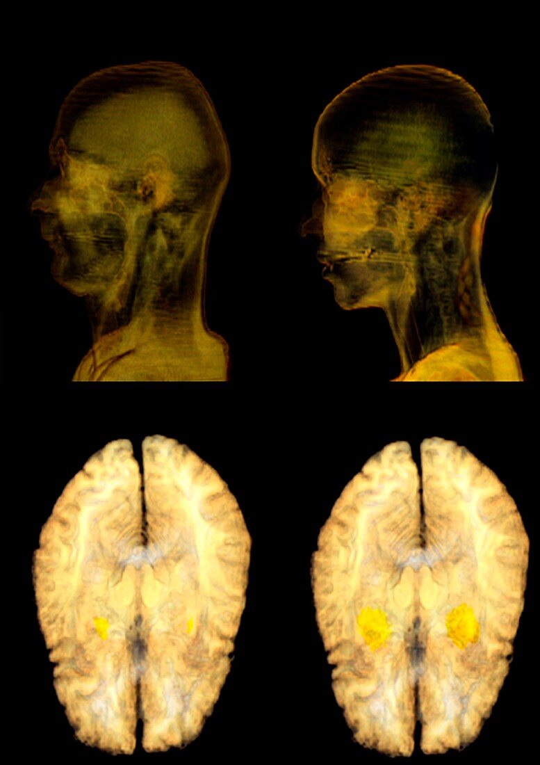 Jealousy research,MRI brain scans