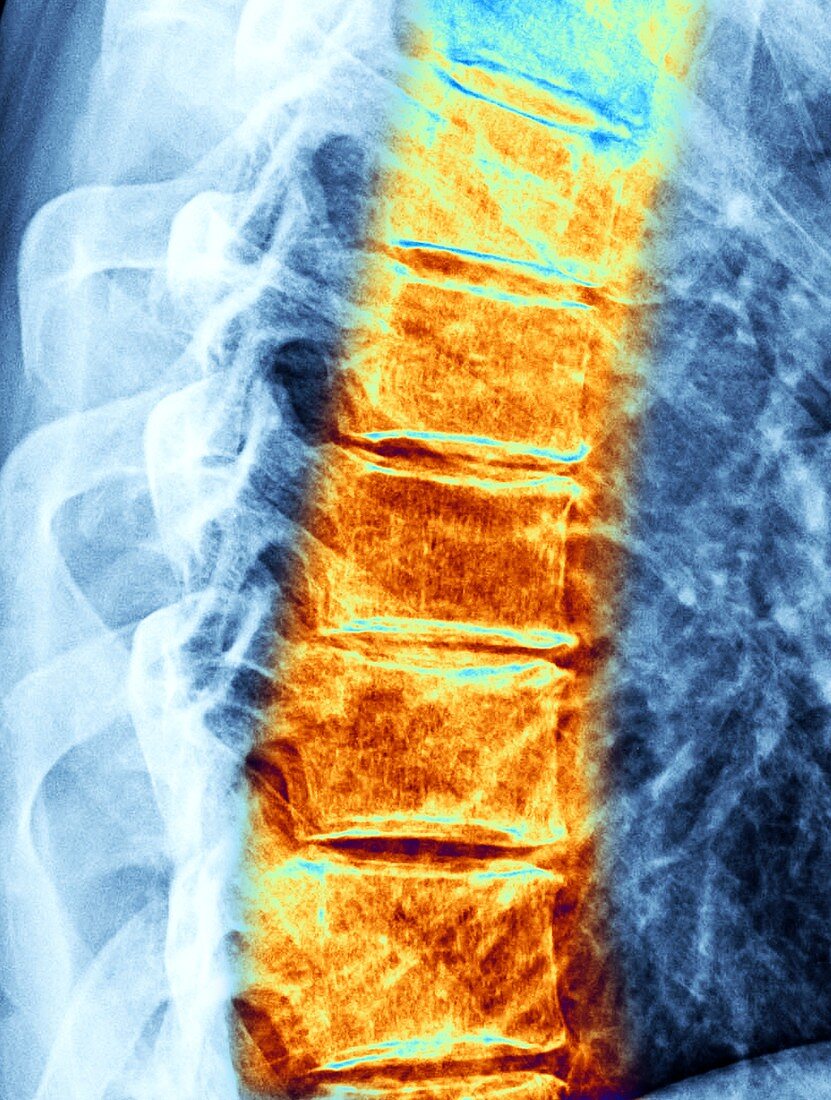 Osteoarthritis of the thoracic spine