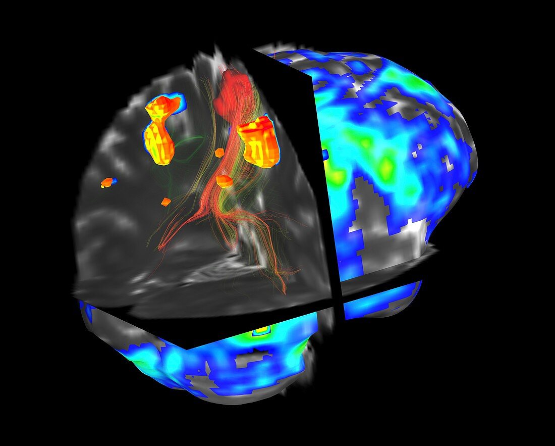 Brain tumour,fMRI and tractography