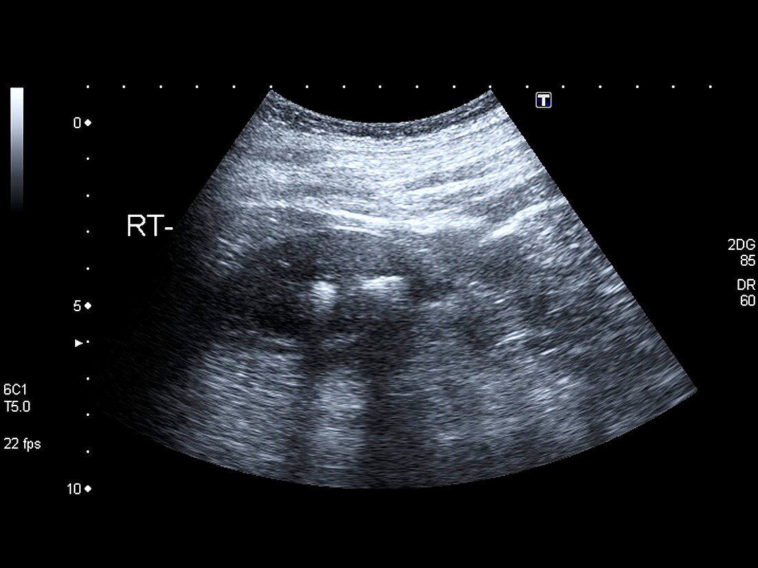 Kidney stones,ultrasound scan