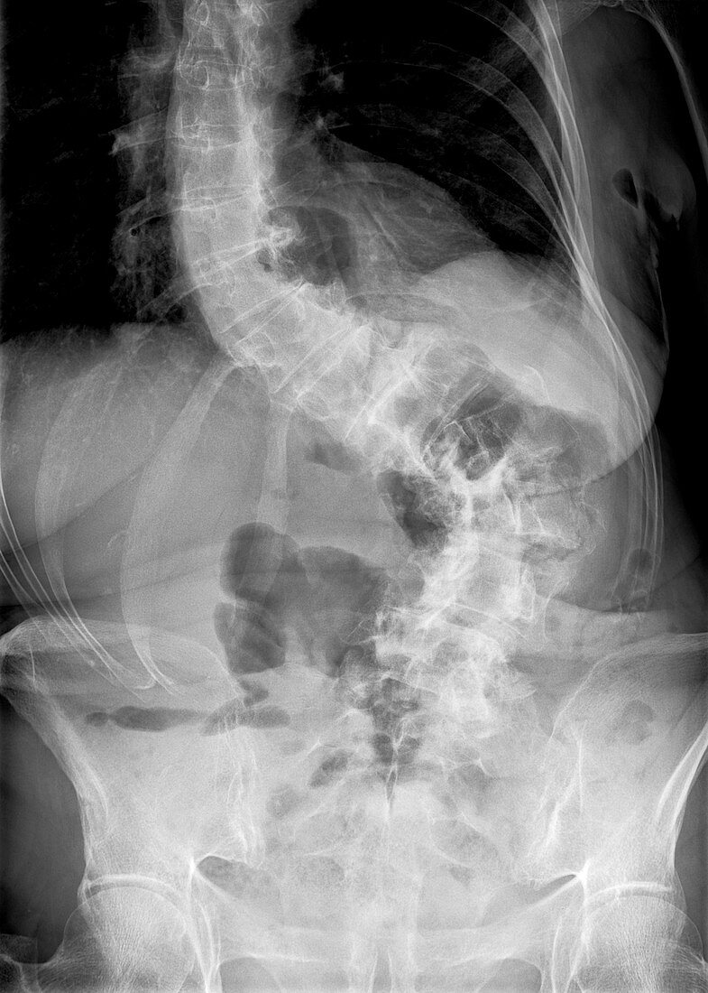 Scoliosis of the spine,X-ray