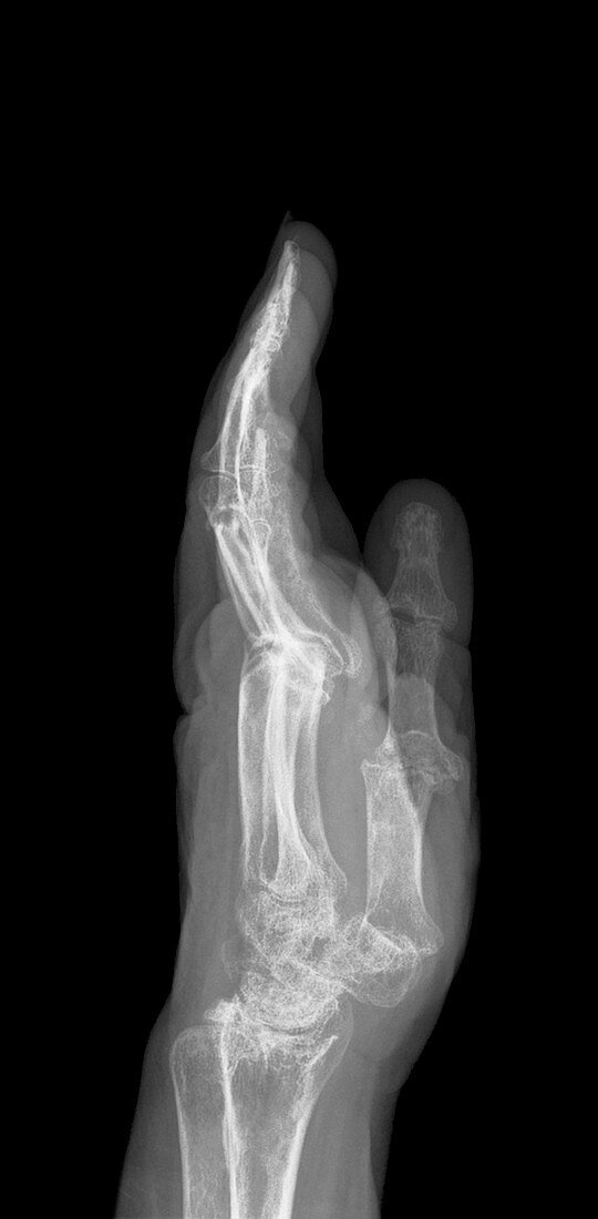 Arthritic hand,X-ray