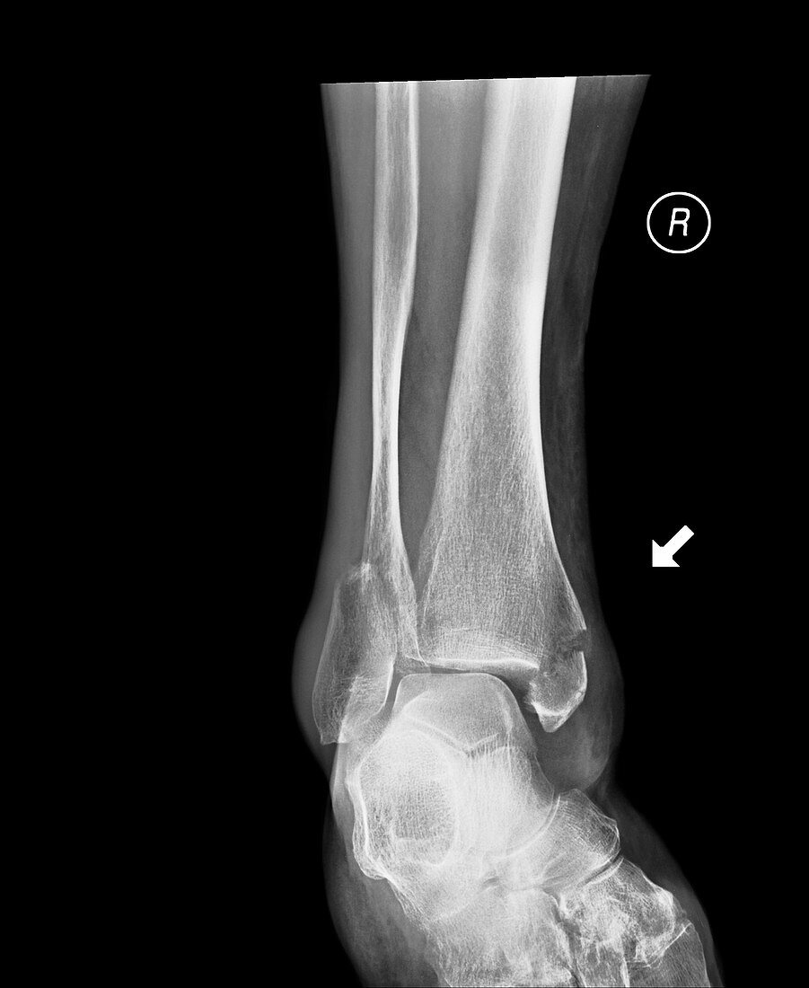 Broken ankle,X-ray