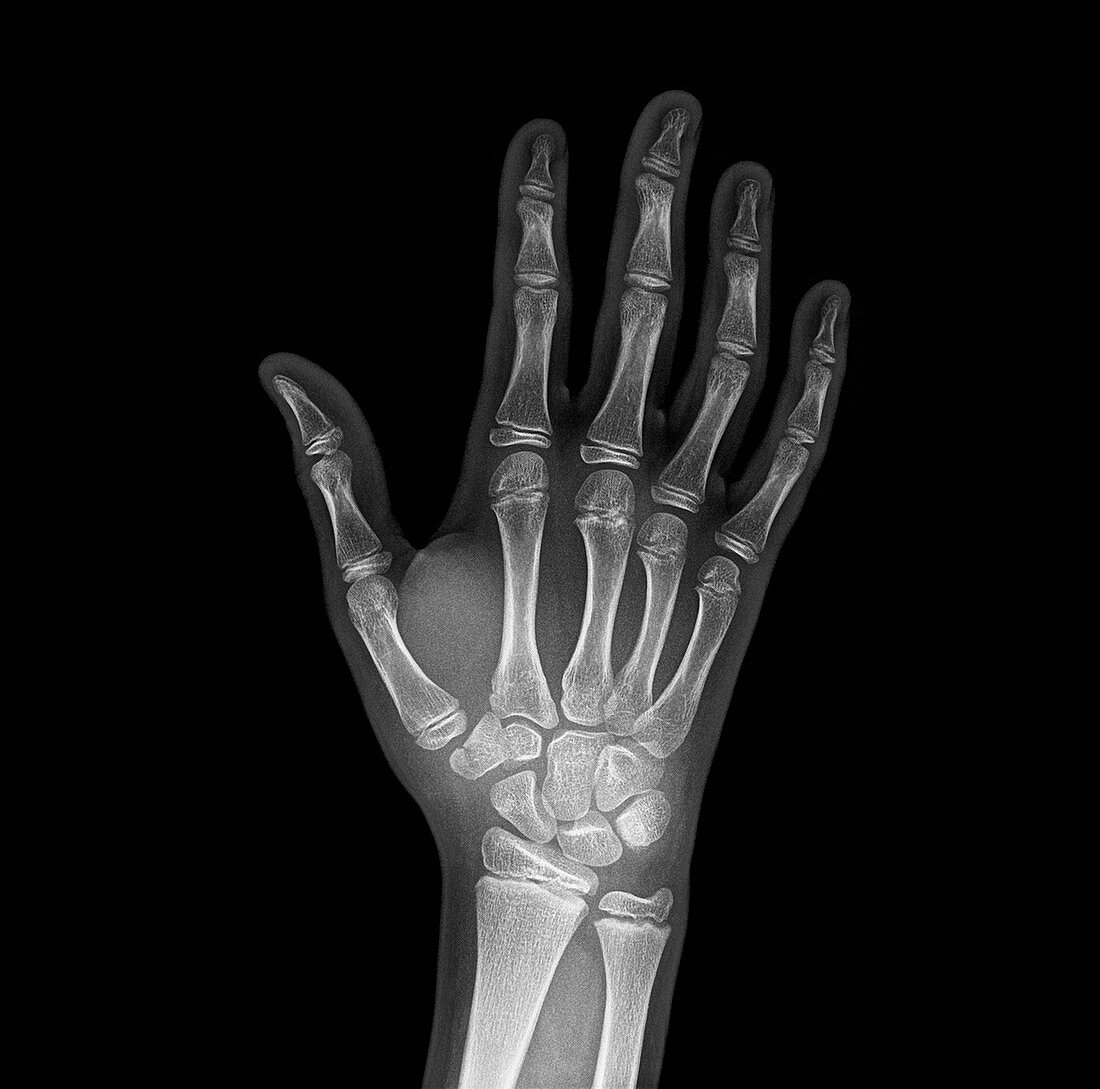 Broken wrist bone,X-ray