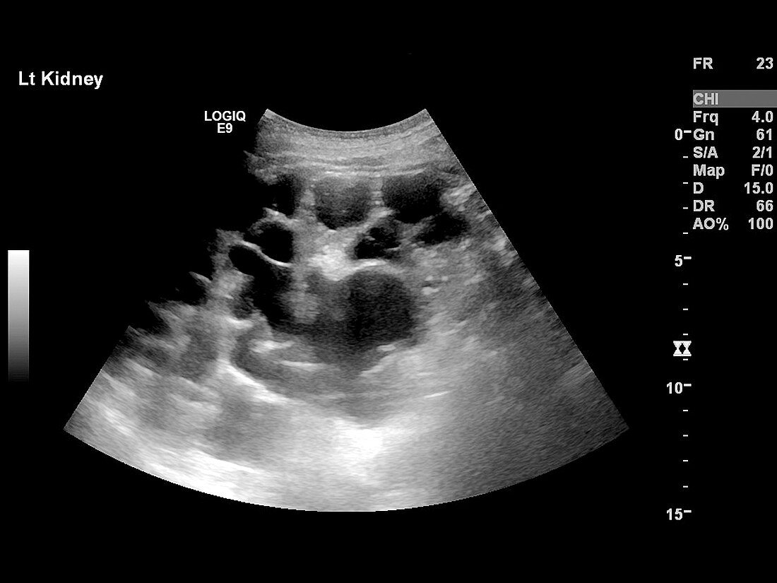 Polycystic kidneys,ultrasound scan