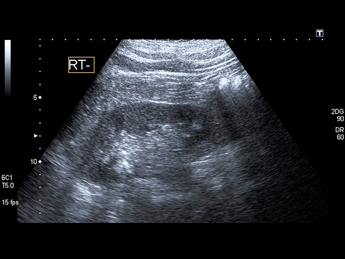 Bladder stones,ultrasound scan