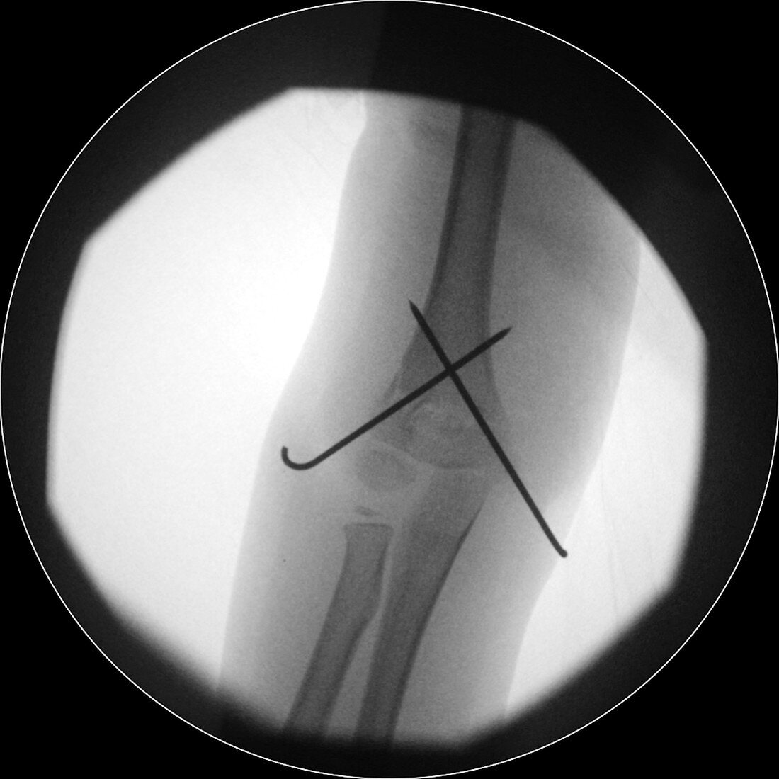 Fixed arm fracture,X-ray