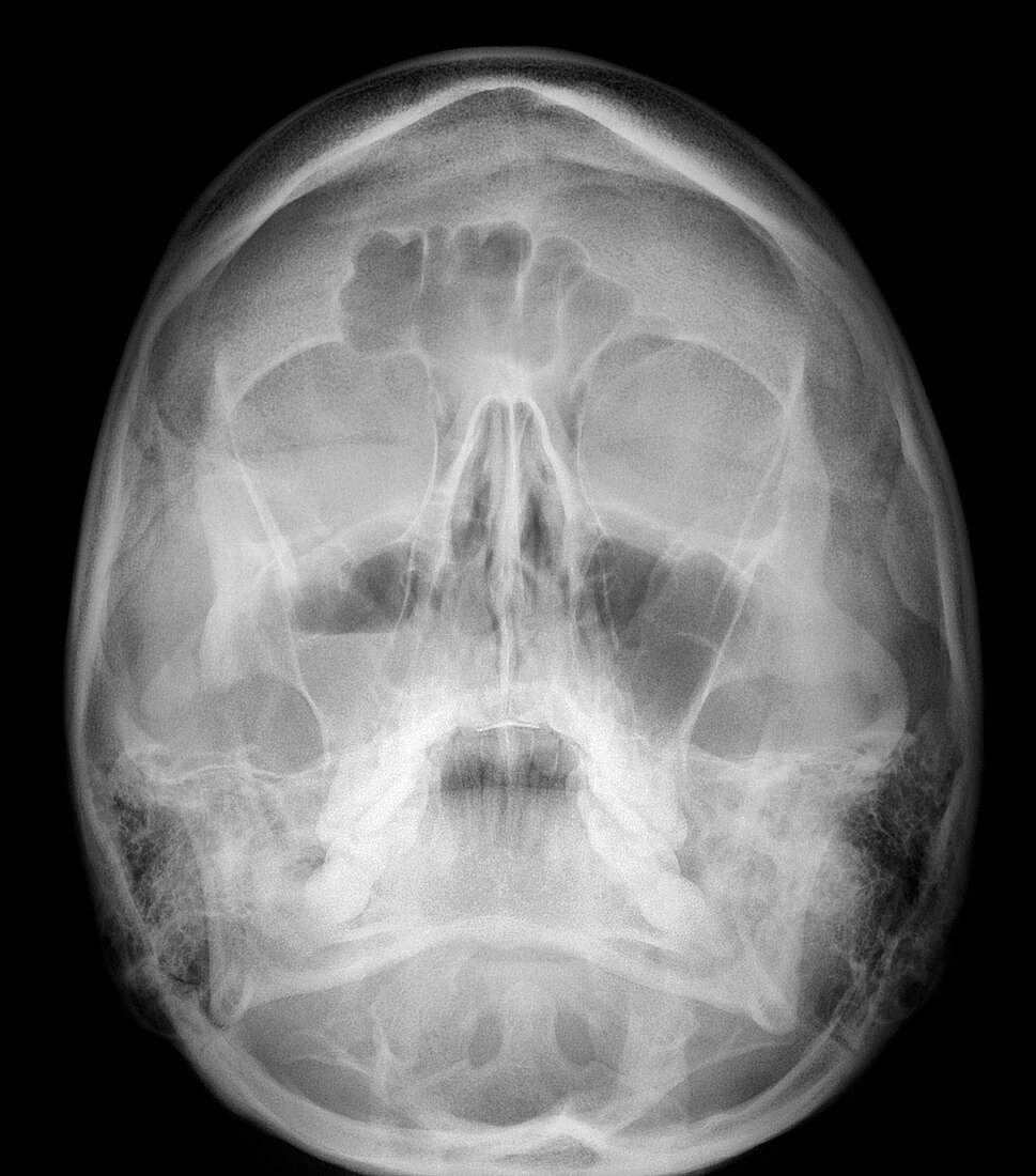 Facial fractures,X-ray
