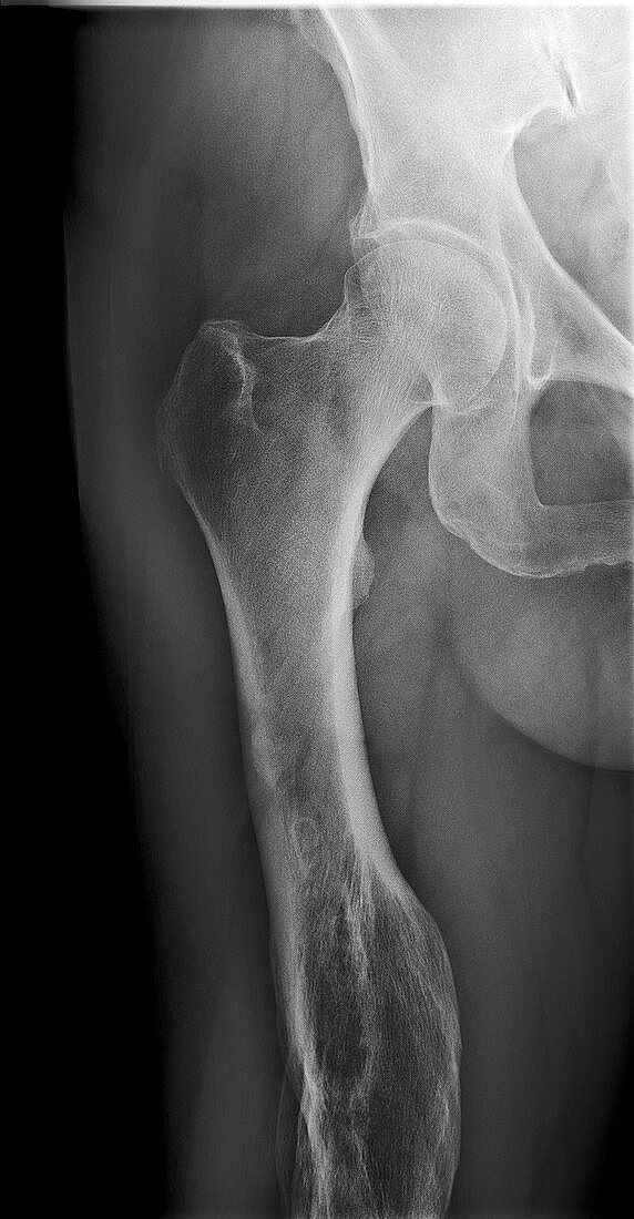 Malunited fracture,X-ray