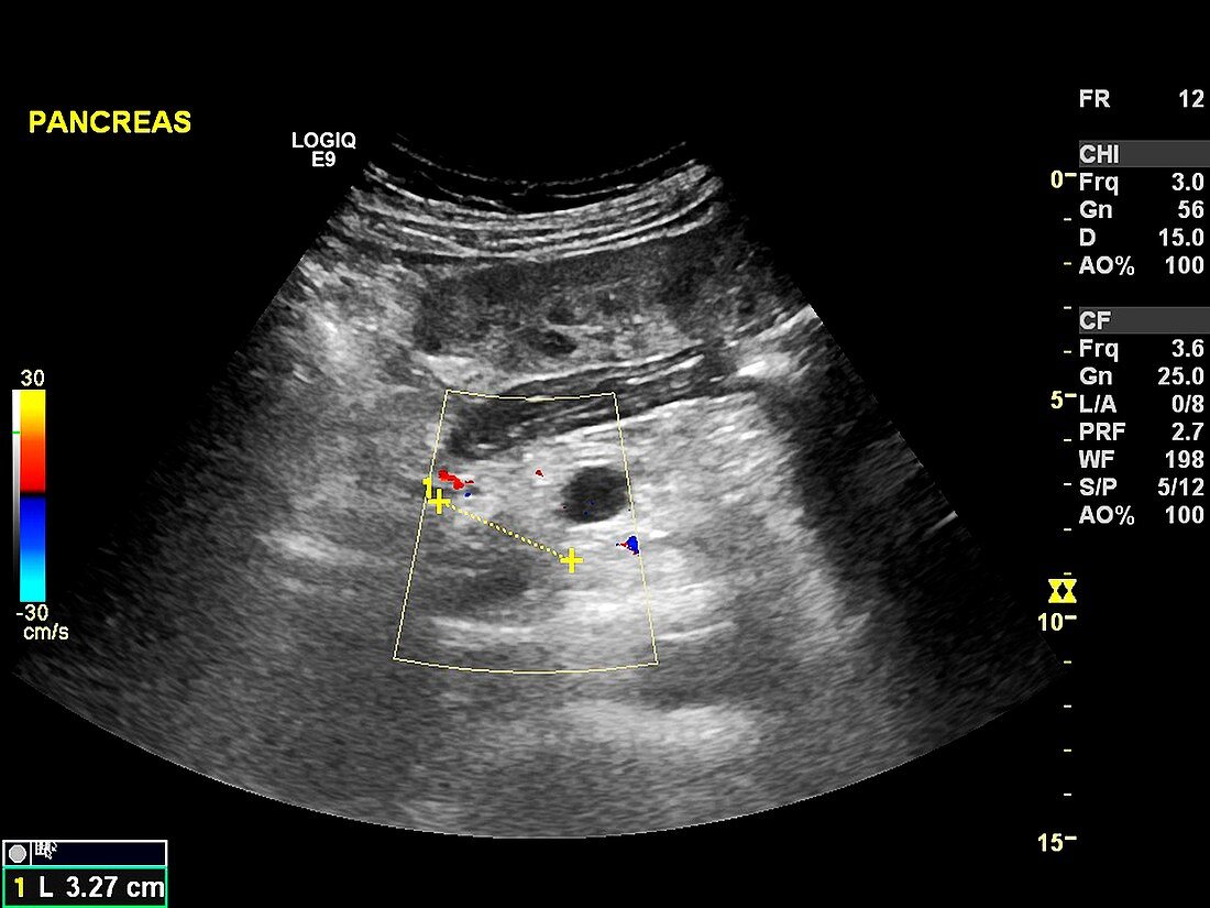 Secondary pancreatic cancer,ultrasound