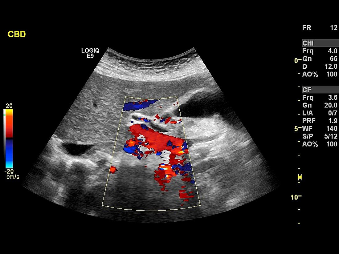 Gallstones,ultrasound scan