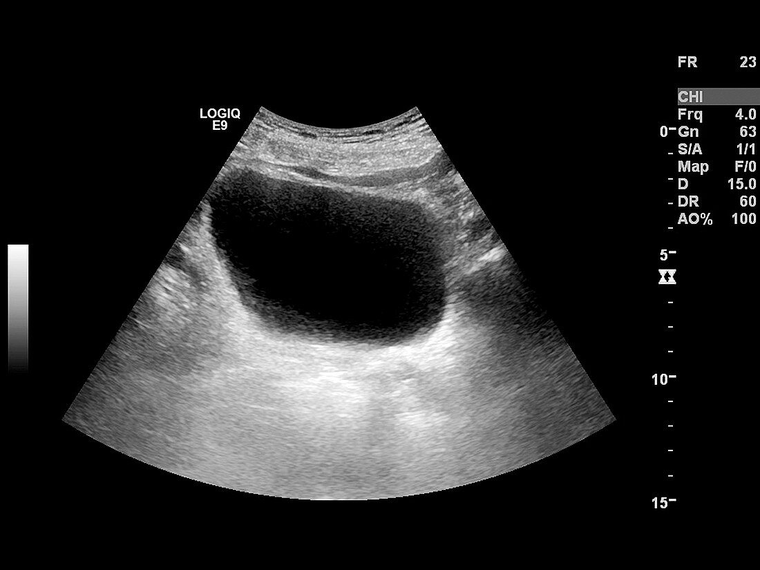 Bladder mass,ultrasound scan