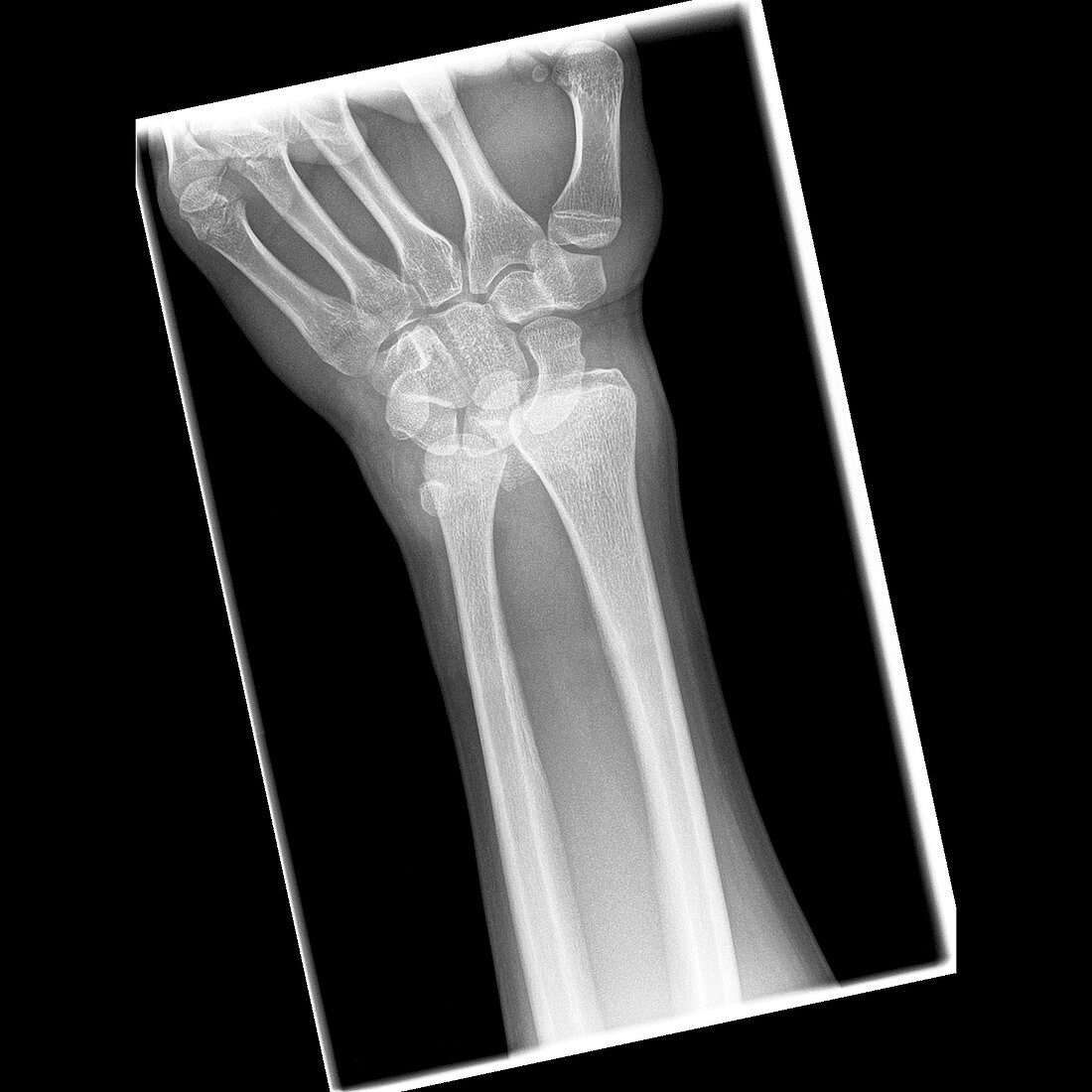 Dislocated wrist,X-ray