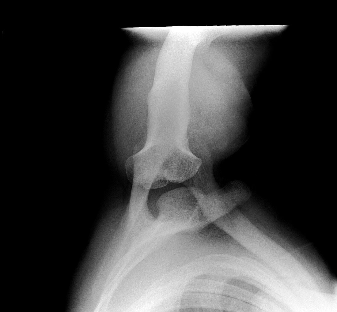 Septic arthritis,X-ray