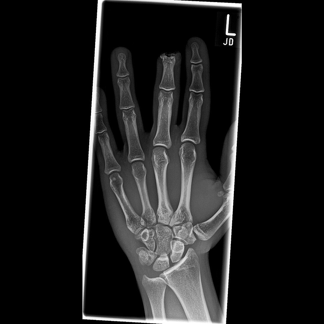 Amputated finger,X-ray