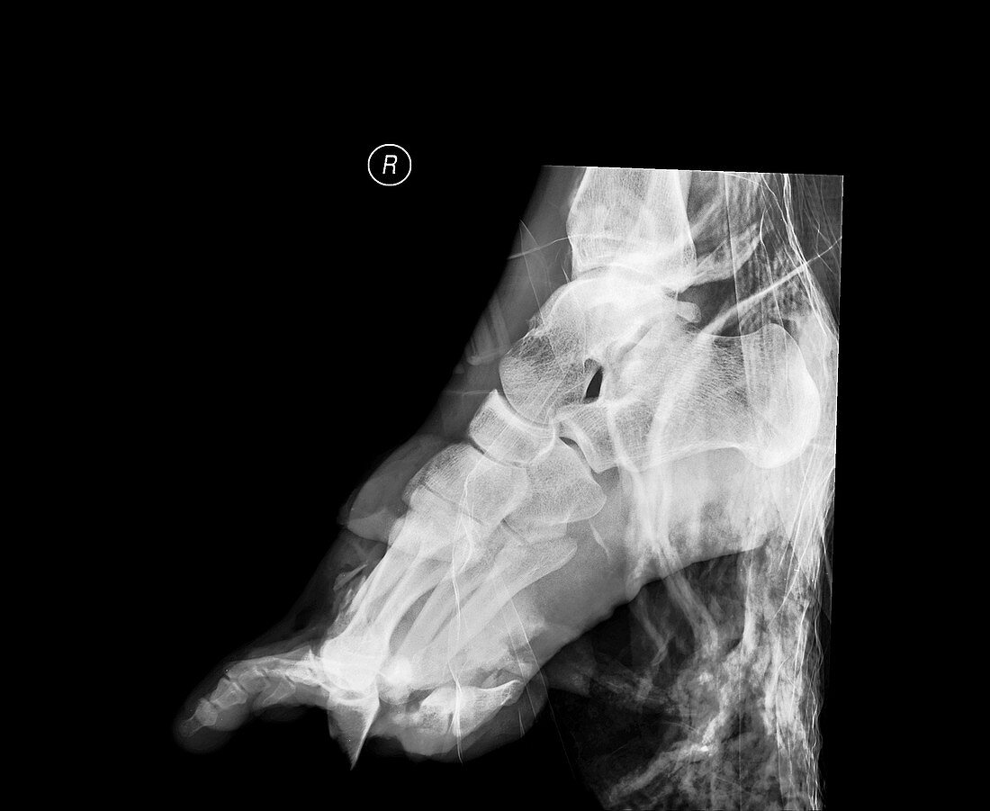 Crushed right foot,X-ray
