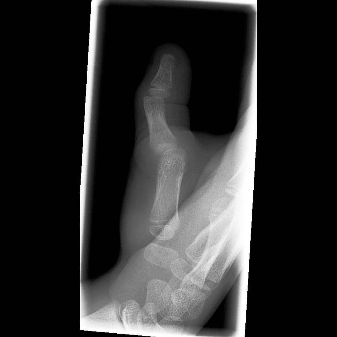 Dislocated thumb,X-ray
