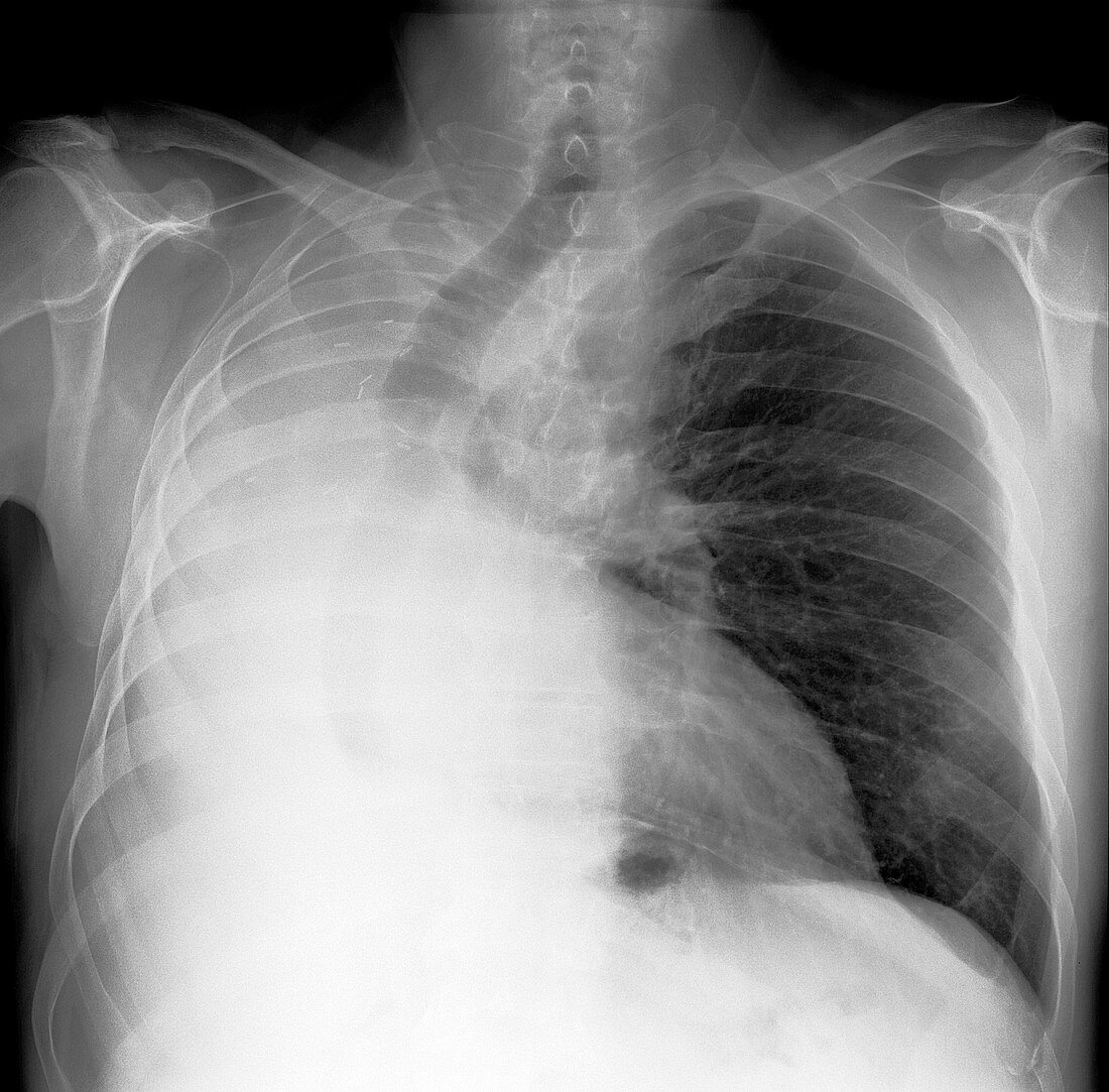 Removed lung,X-ray