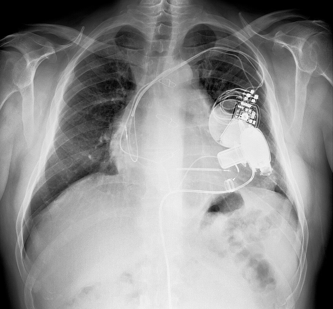 Pacemaker and heart pump,X-ray