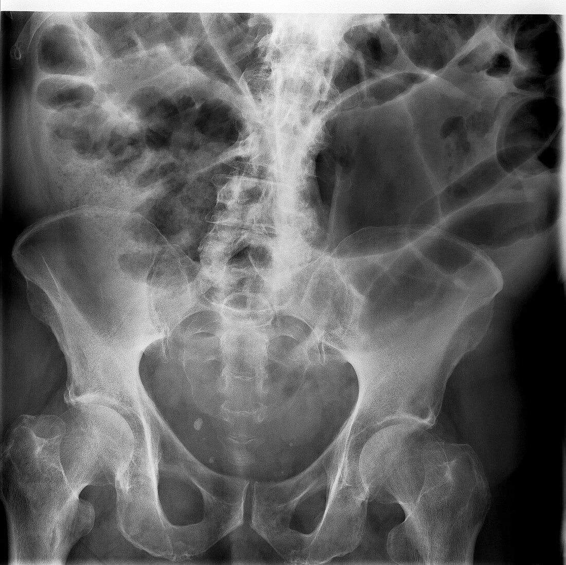 Large bowel obstruction,X-ray