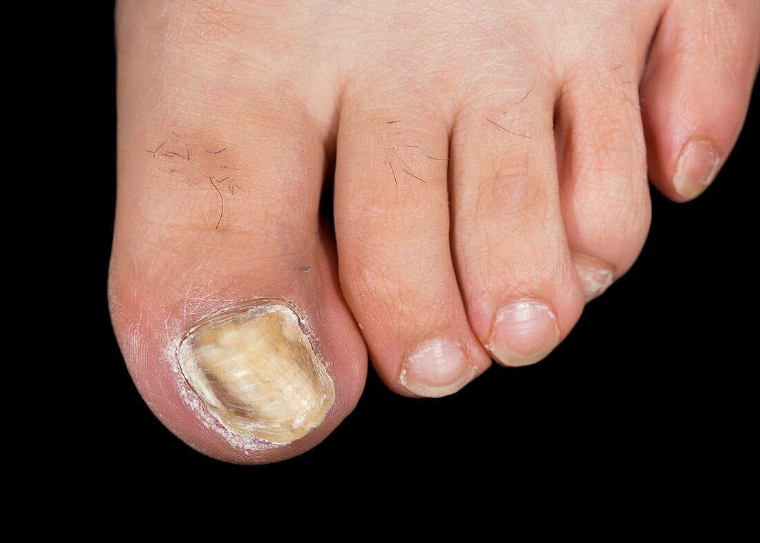 Fungal infection of toenail