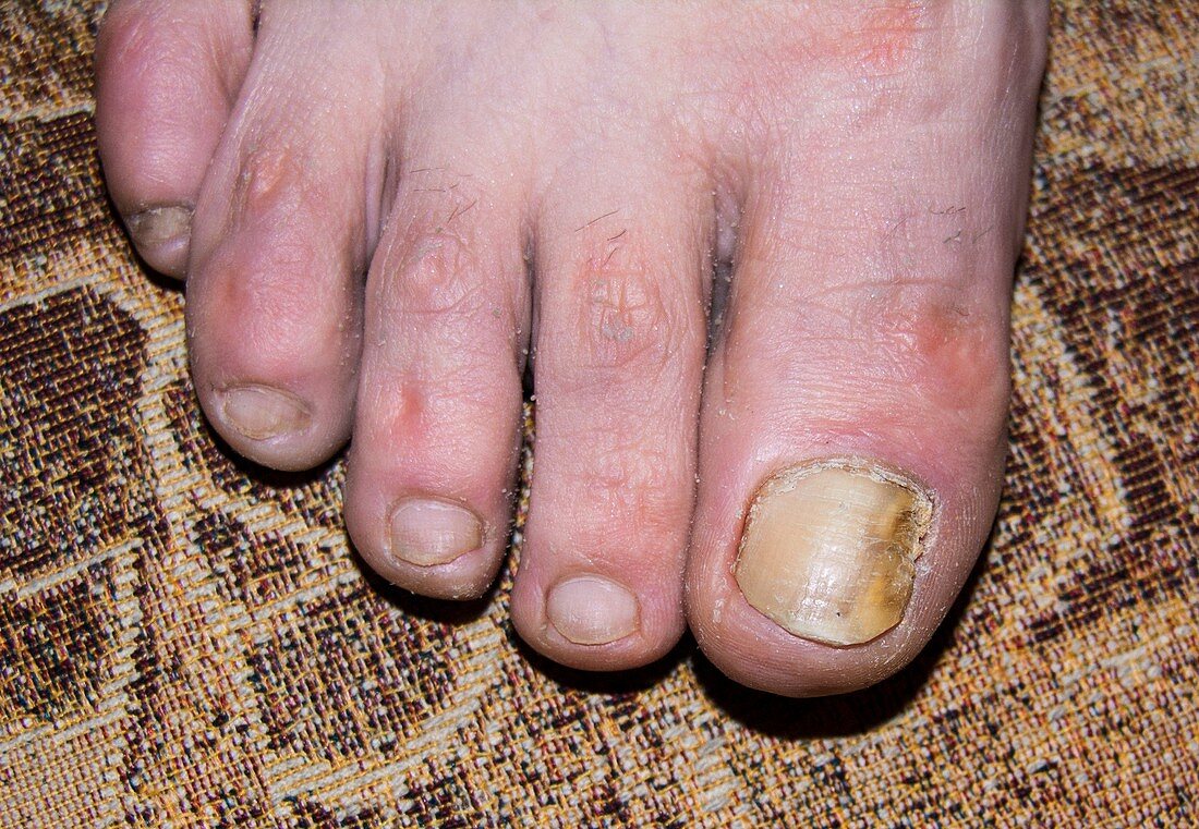 Fungal infection of toenail