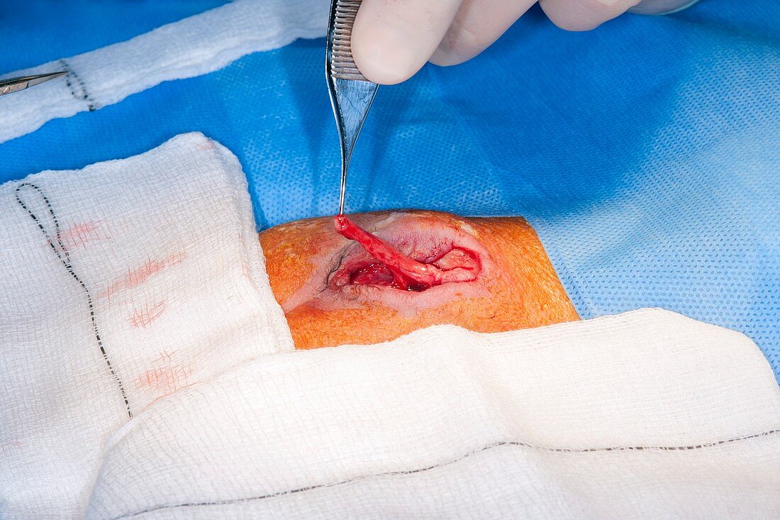 Myelomeningocele repair surgery