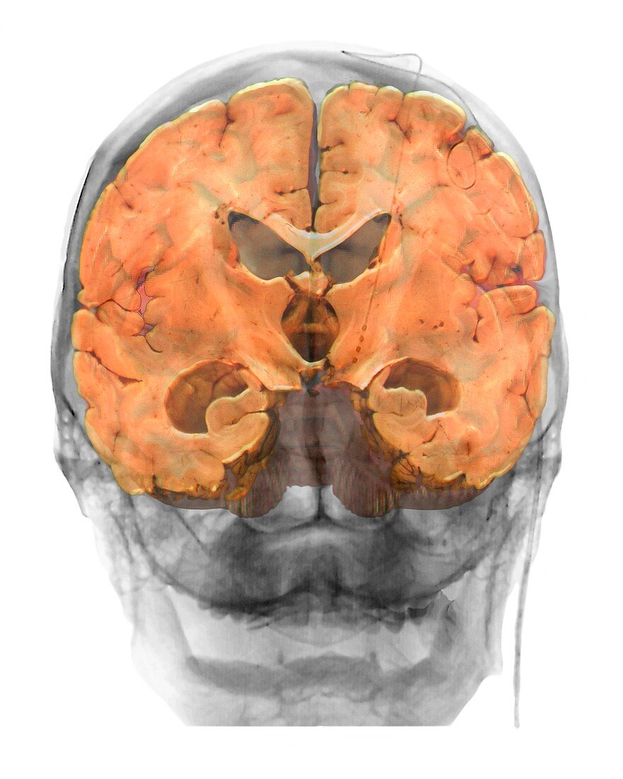 Brain implants for Parkinson's disease
