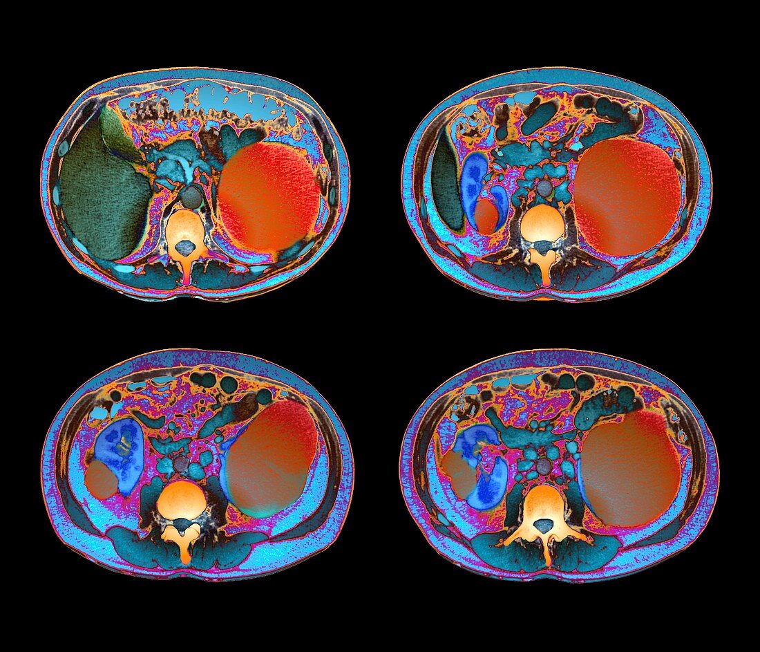 Polycystic kidneys,CT scans