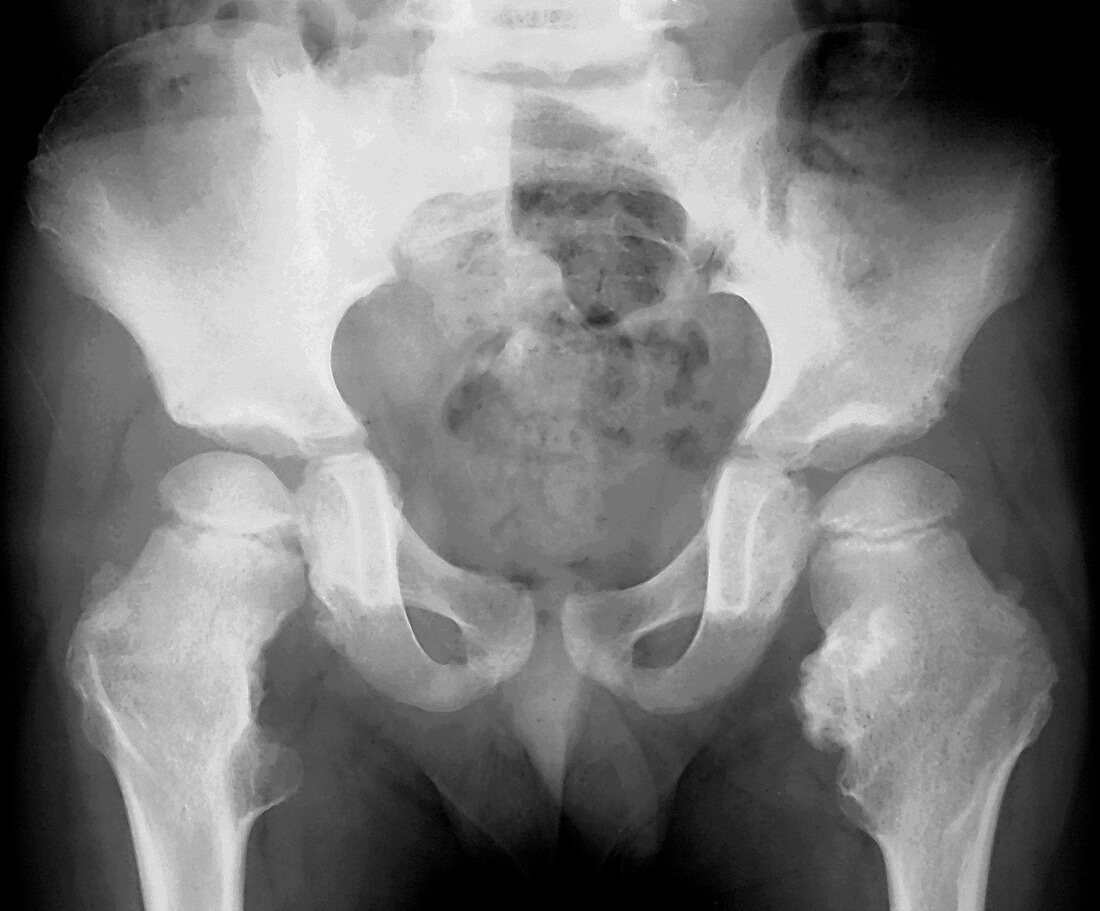 Bone growths,X-ray