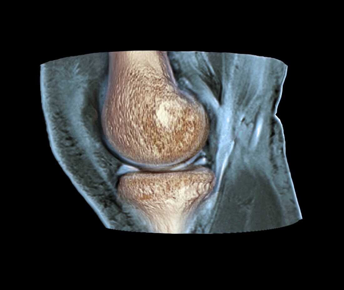 Knee injury,3D CT scan