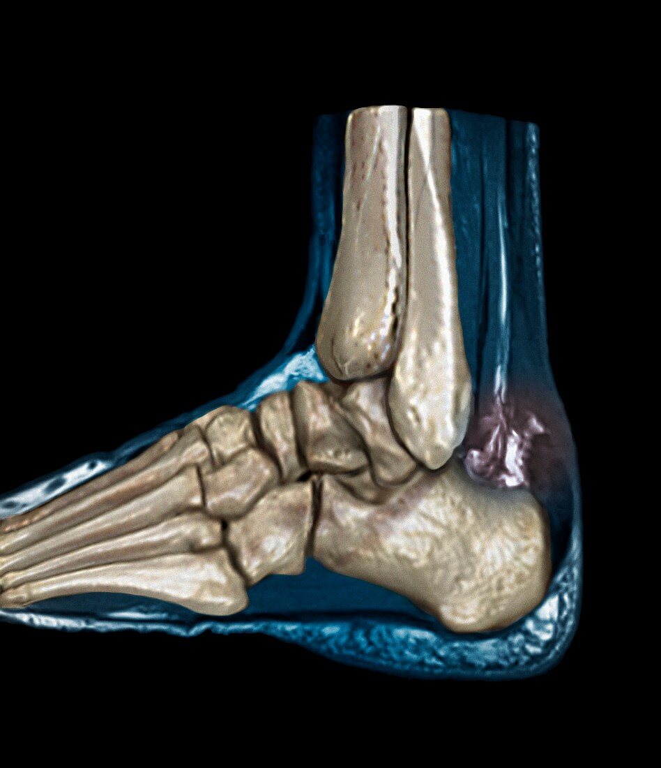 Ruptured Achilles tendon,MRI