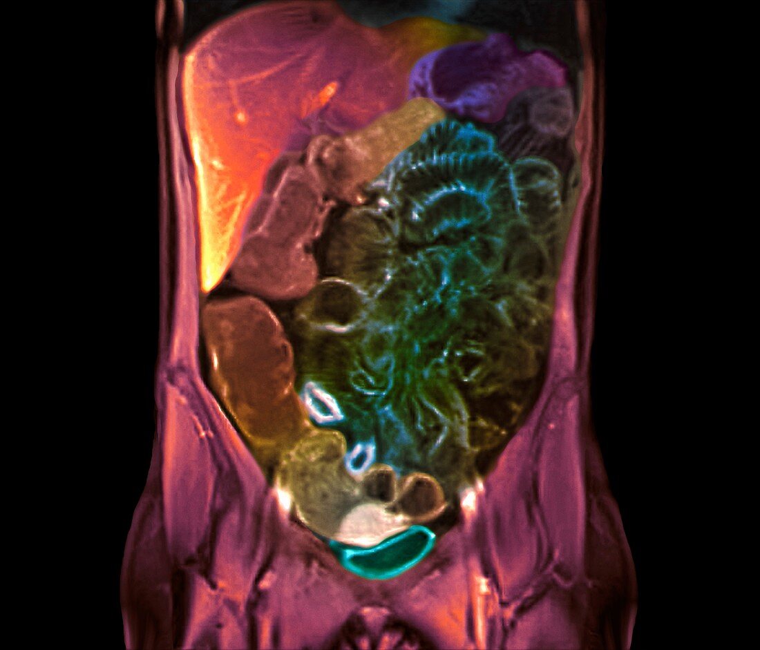 Healthy abdomen,MRI scan