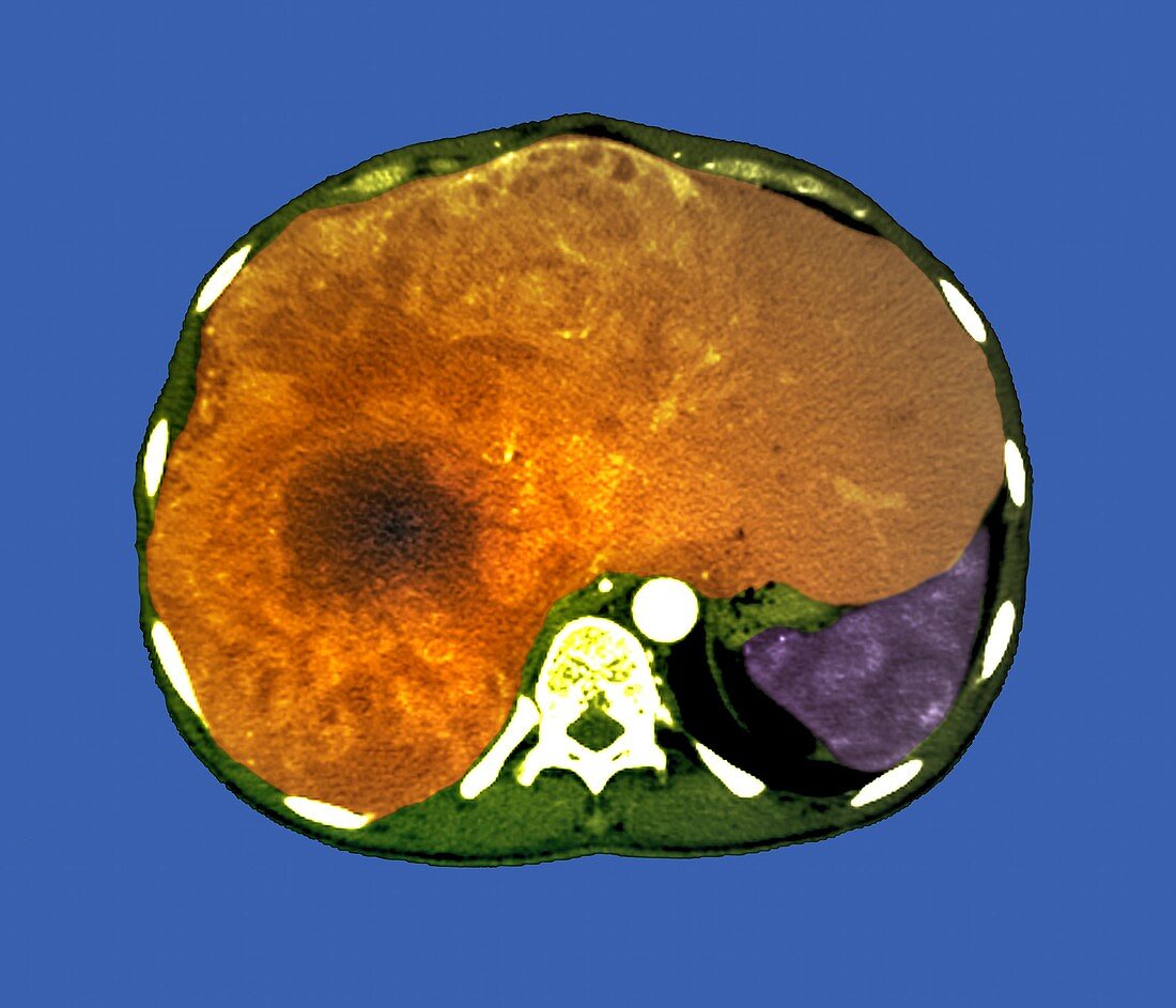 Liver cancer,CT scan