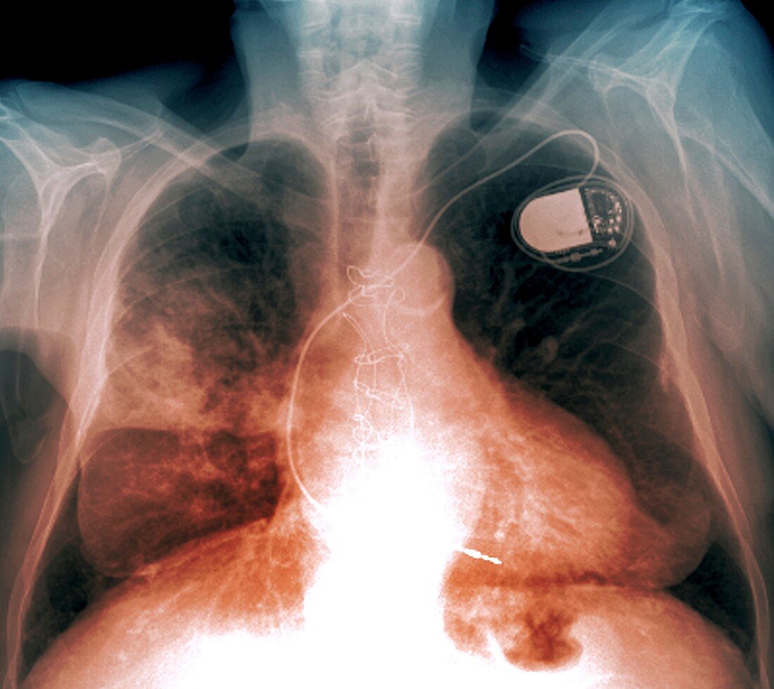 Heart and lung disease,X-ray