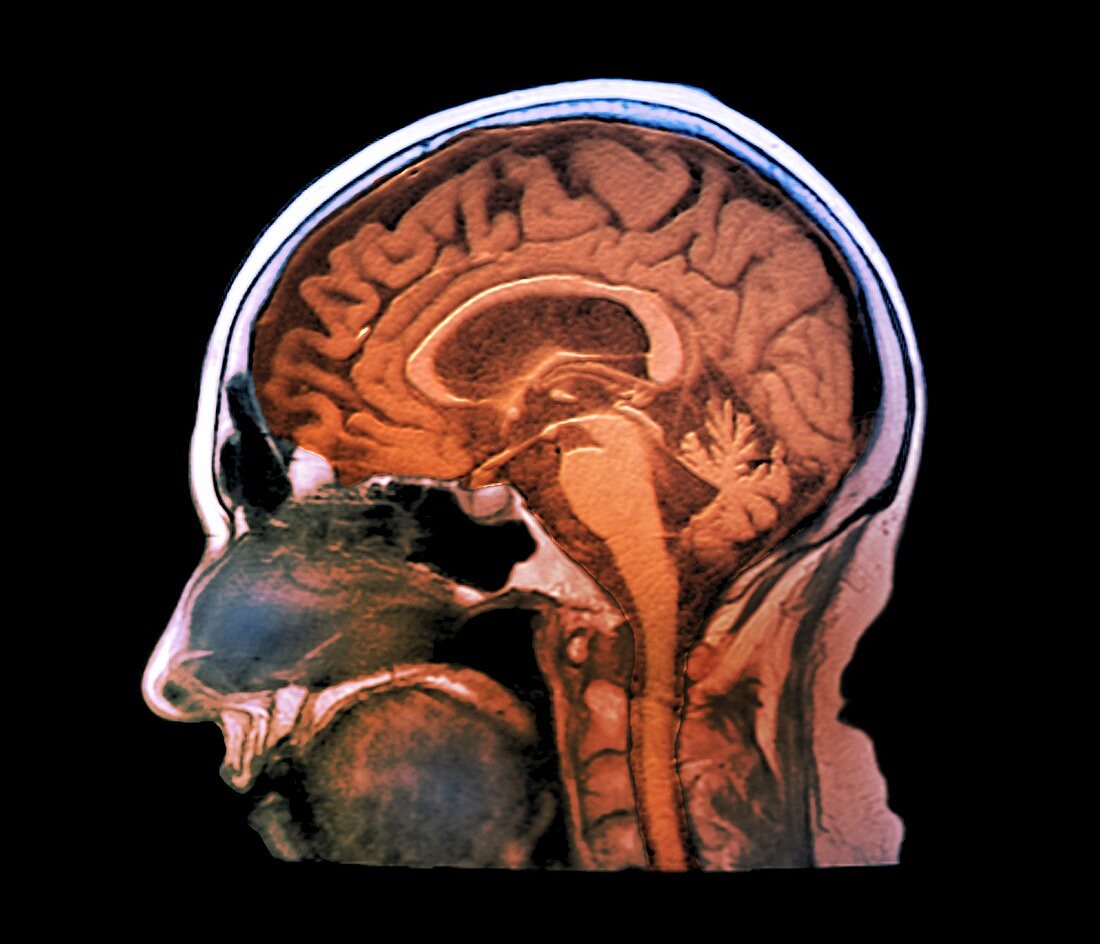 Cerebrotendinous xanthomatosis,MRI scan