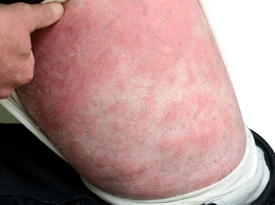 Eczema