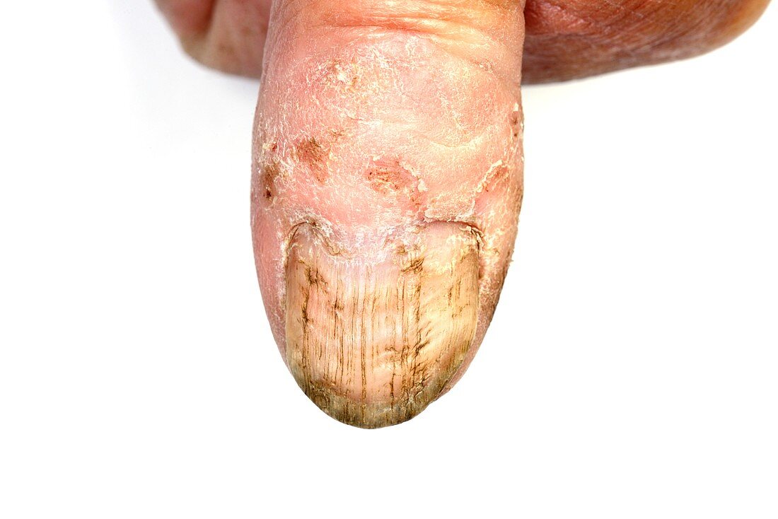 Injured nail