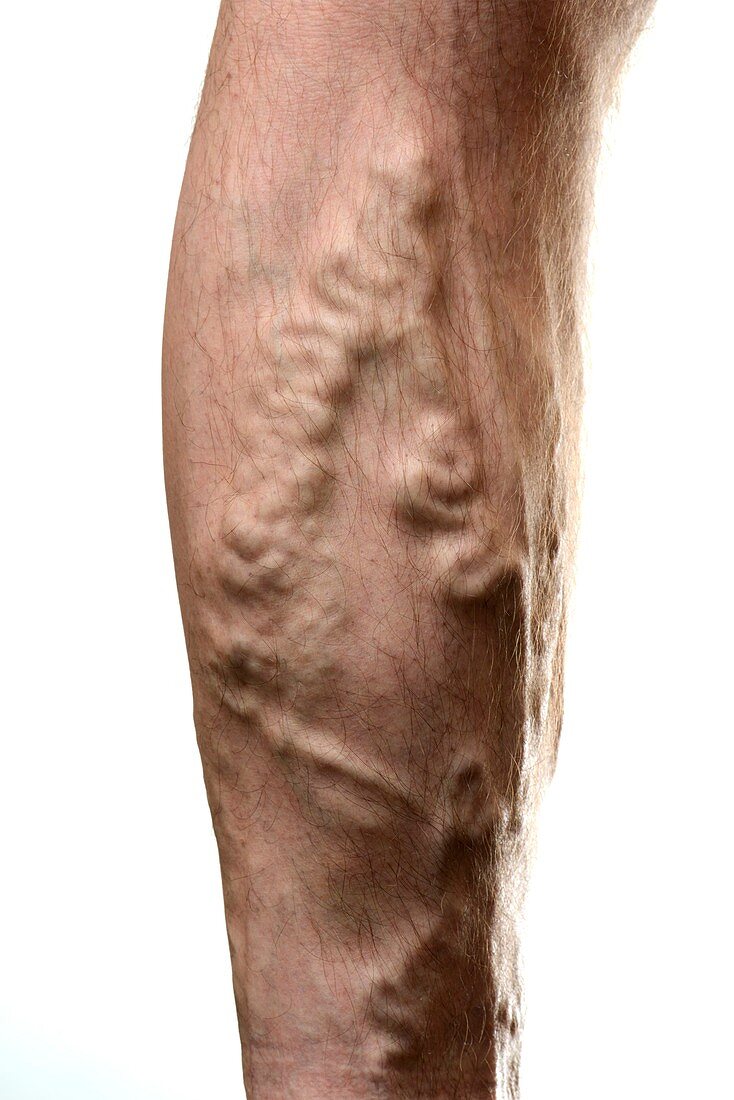 Varicose veins